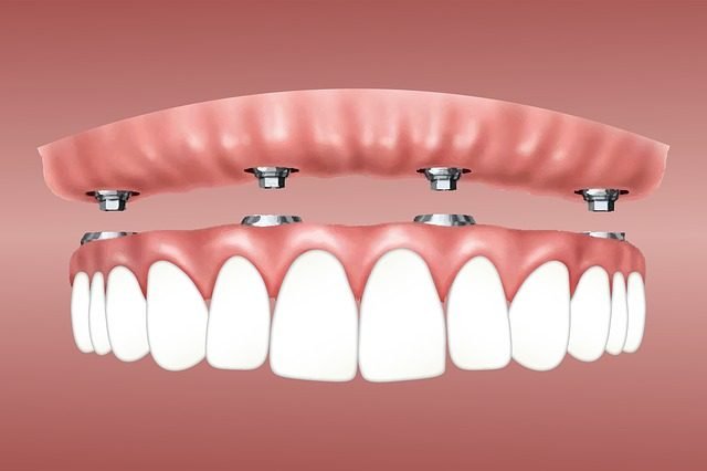 dental implants services in agra