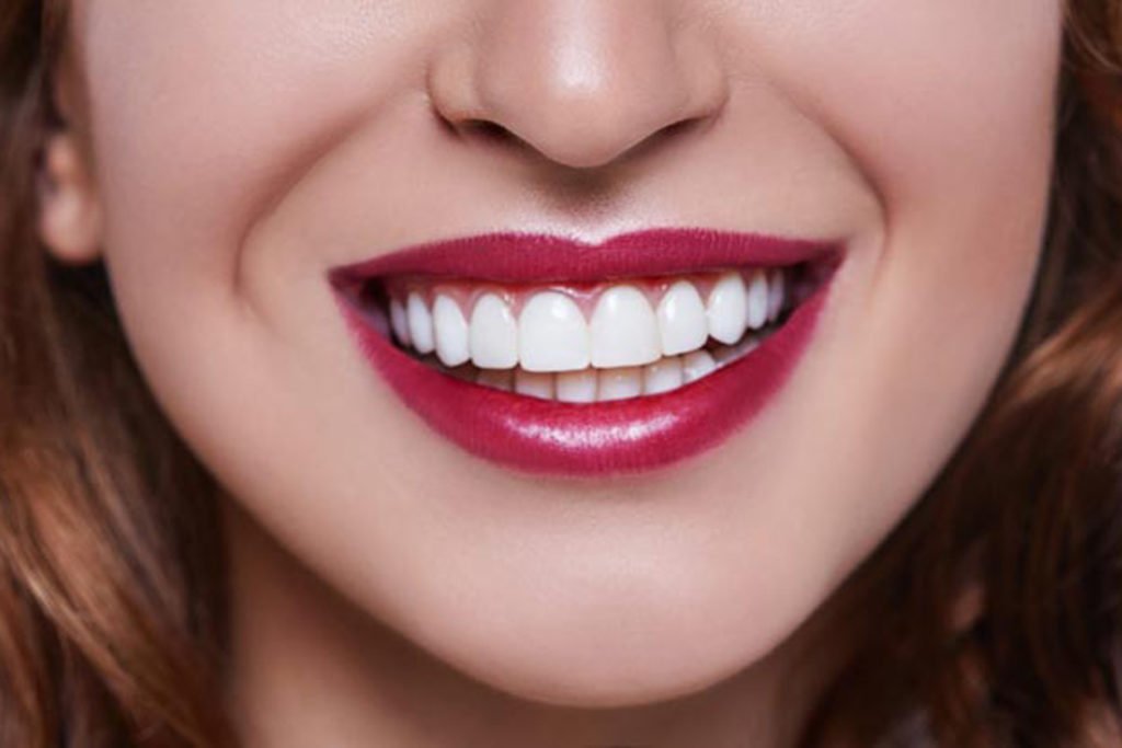 dental Veneers services in agra