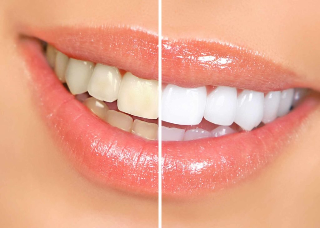 teeth whitening services in agra
