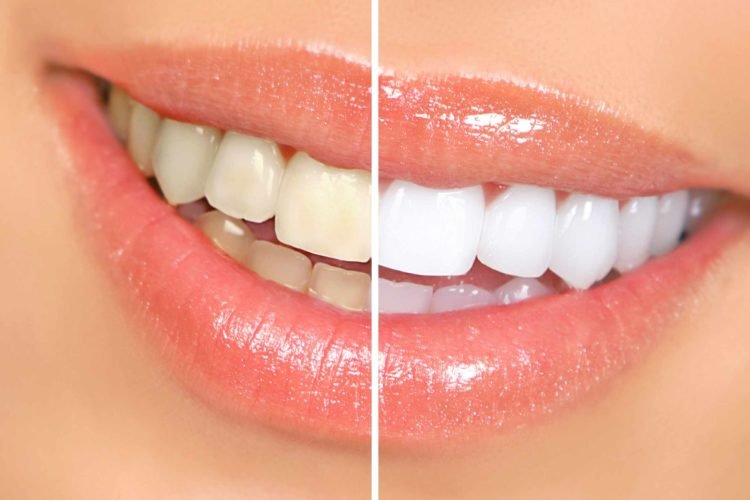 teeth whitening services in agra