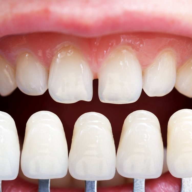 dental veneers